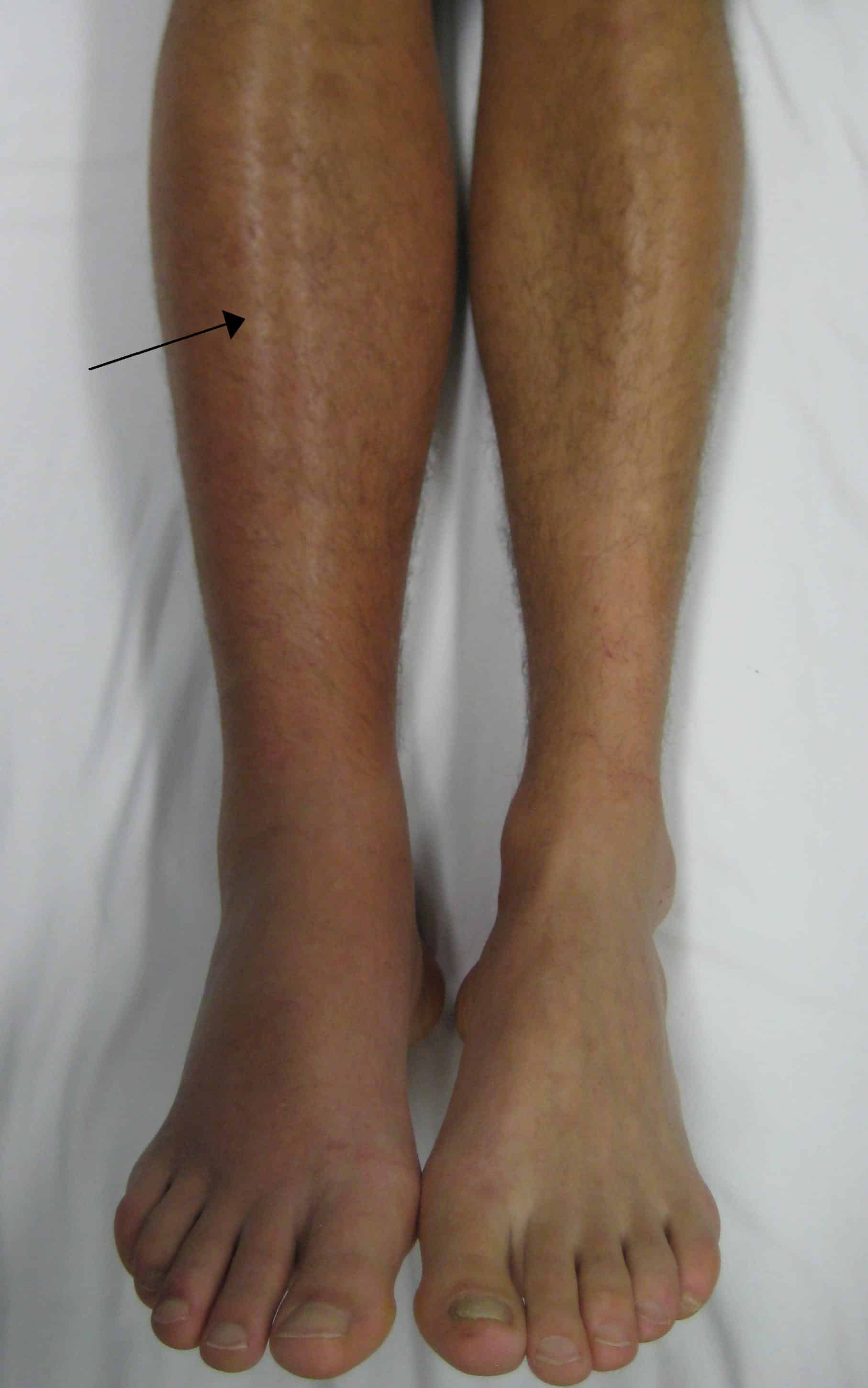 Fig 2 - Deep vein thrombosis in the right leg. The leg is swollen and red.