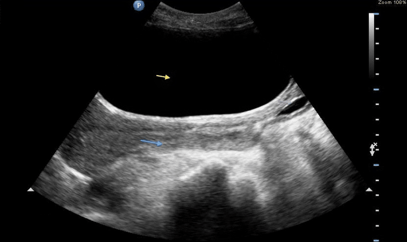 Fig 1 - Ultrasound bladder scan, showing an enlarged bladder with urinary retention (yellow arrow). By Massinde Anthony [CC-BY 3.0], from International Journal of Case Reports in Medicine