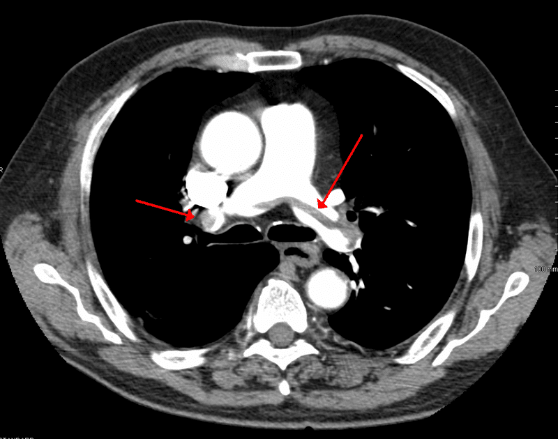 Fig 3 - CTPA scan showing a large pulmonary embolism at the bifurcation of the pulmonary artery