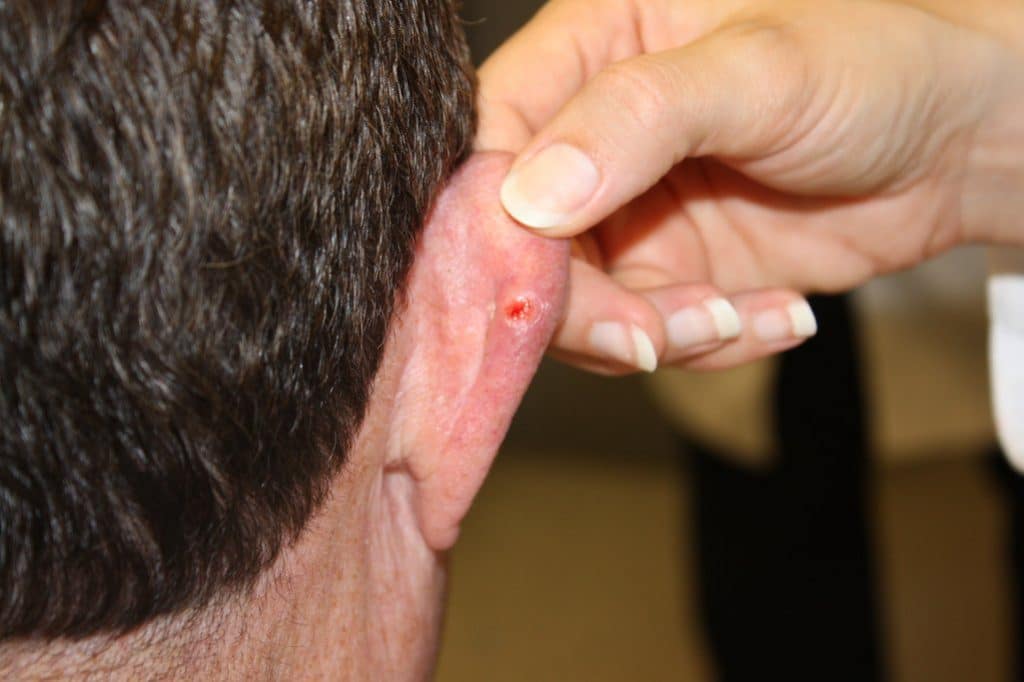 Fig 1 - Basal cell carcinoma, located on the posterior aspect of the outer ear.