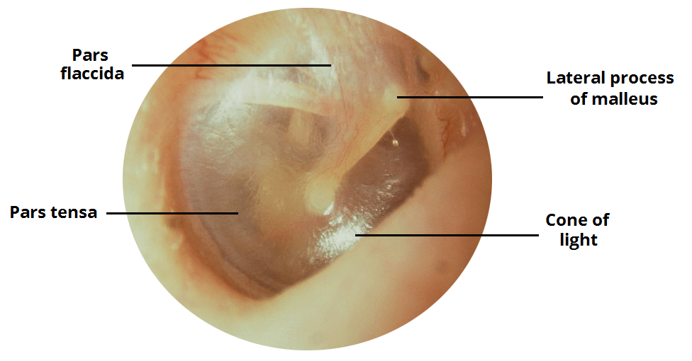 Fig 2 - A normal right tympanic membrane.