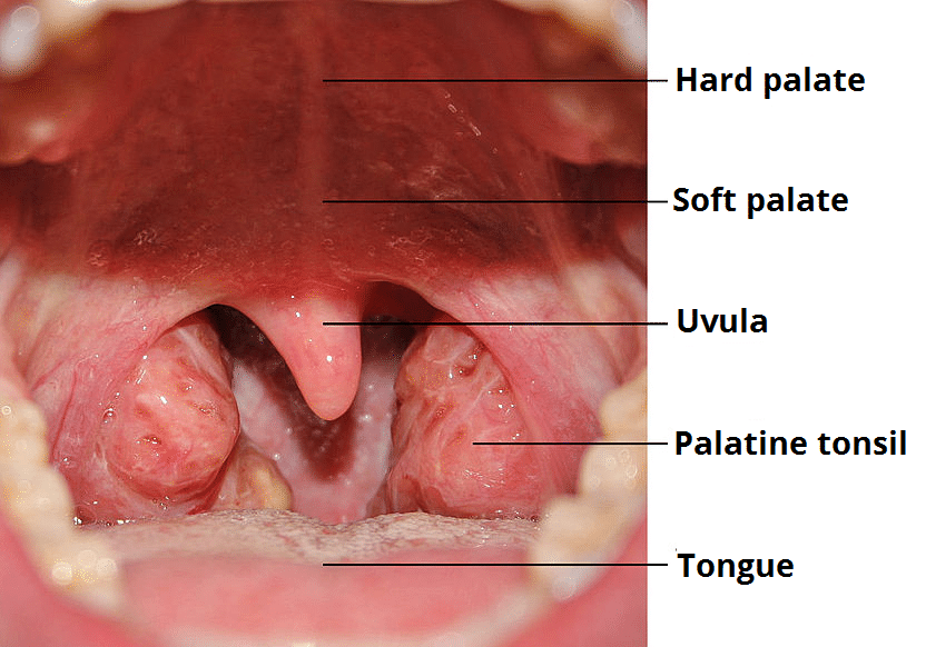 Fig 1 - The hard palate, soft palate, uvula, tonsils and tongue.